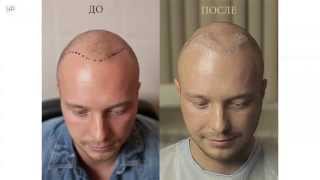 Пересадка волос по методу клиники HFE