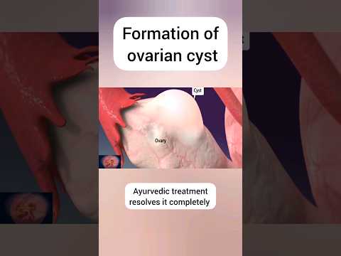 ovarian cyst #shorts #shortvideo #viral