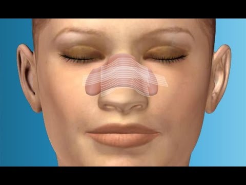 Doctorul Rancaciovean | Nose Surgery