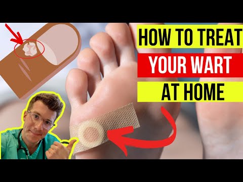 Doctor explains how to treat WARTS at home (plus when to seek medical attention)