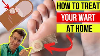 Doctor explains how to treat WARTS at home (plus when to seek medical attention)