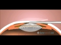 Implantable Corrective Lenses (ICL) (English) - Dr. Shady Awwad Implantable Corrective Lenses (ICL) (English)