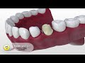 Cerec - The ultimate chair side Cad Cam Technology