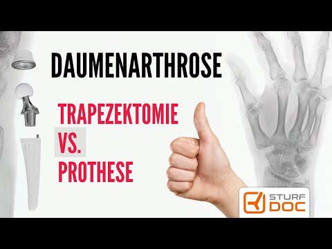 Prosthesis better than trapezectomy for thumb carpometacarpal joint arthrosis - rhizarthrosis