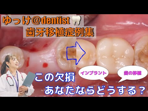 生命歯学科 【歯牙移植症例集】この欠損あなたならどうする？欠損部分に対しての歯牙移植法を解説🦷歯牙レプリカ、再生療法を併用した歯の移植法をご紹介します！