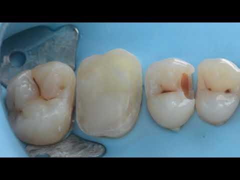 Direct And Indirect Restorations In The Same Quadrant Performed With Rubber Dam Isolation