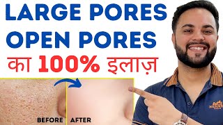 Open Pores, Large Pores, Clogged Pores Permanent Treatment
