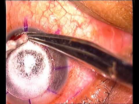 Ectasie post-LASIK - KLAP/DALK