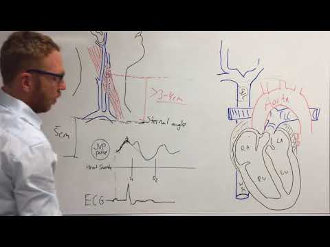 Jugular venous pressure