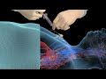 Accessing An Implantable Port Training 3D Animation