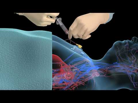 Accessing an implantable port training - 3D animation