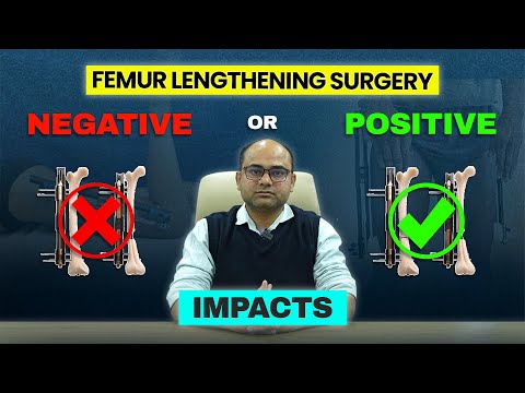 Femur Lengthening Surgery: Positive vs Negative Impacts | Doctor Explains | Heights Plus