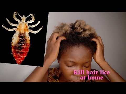 HOW TO KILL HAIR LICE AT HOME (with 2 easy steps) THAT WORKS / how to get rid of lice