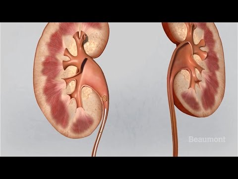 Kidney Stones Symptoms and Treatments