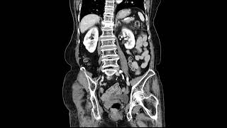 Download the video "rectal cancer2"