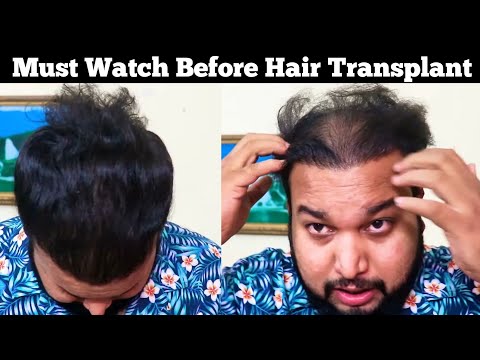 Reality Of Hair Transplant After 3 Years || Best Hair...