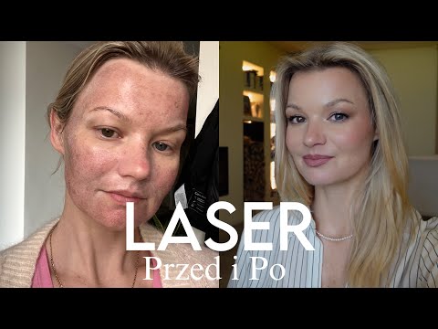 LASEROWE USUWANIE PRZEBARWIEŃ zrobiłam to!! Rekonwalescencja, który laser wybrać, pielęgnacja po!