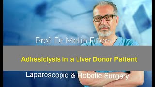 Miniaturka - Laparoscopic Adhesiolysis in a Liver Donor Patient. MD FACS Metin Ertem