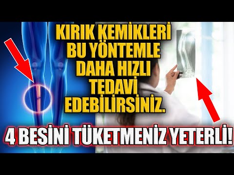 , title : 'Kırık Kemikleri Bu Yöntemle Daha Hızlı Tedavi Edebilirsiniz. 4 BESİNİ TÜKETMENİZ YETERLİ!'