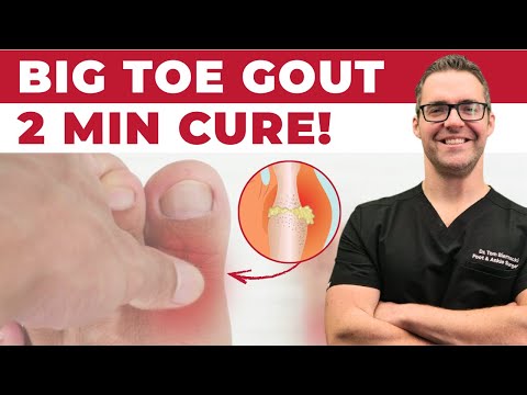 Gout Attack in the Big Toe Joint & Foot Diet & Treatment *2 MINUTES!*