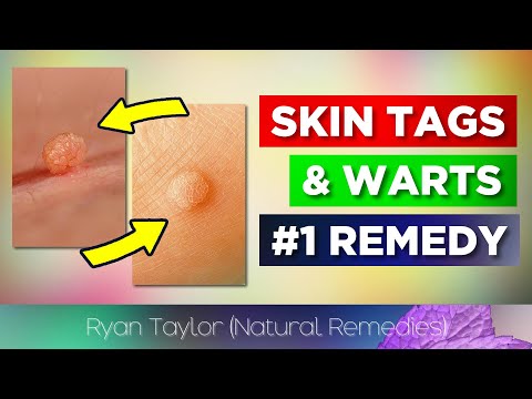 Use Iodine for Skin Tags & Warts (Removal)