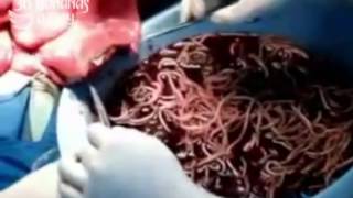 GROSS! Bodybuilder colon with 10lbs of "meat worms" infestation