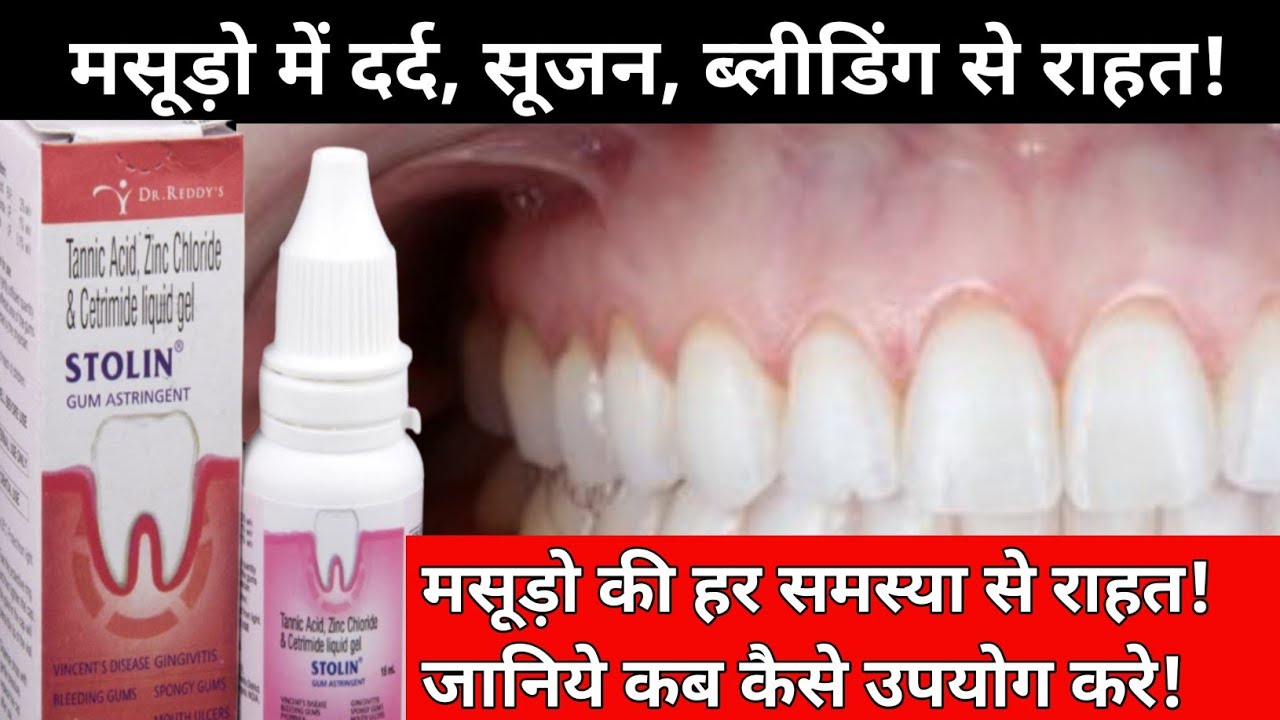 stolin gum paint ||मसूड़ो में दर्द सूजन ब्लीडिंग से राहत! Stolin Gum Astringent ||STALIN GUM PAINT !