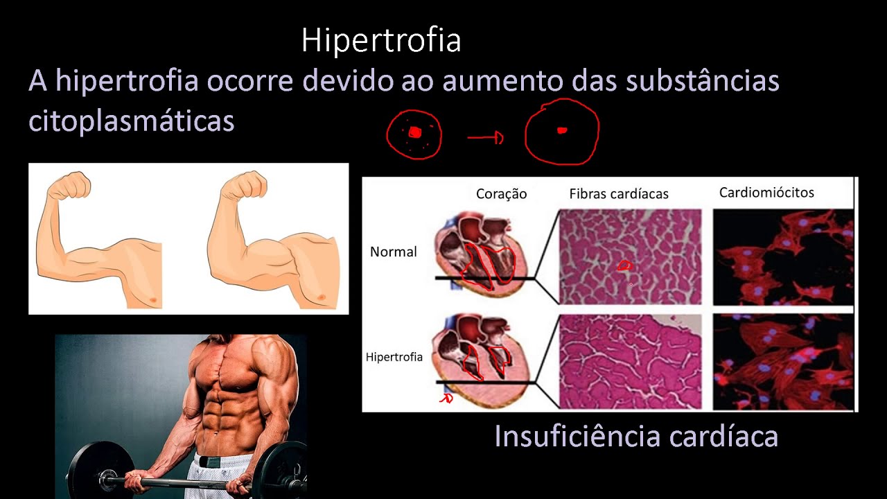 Patologia básica/ Adaptações celulares: Hipertrofia, hiperplasia, metaplasia e atrofia