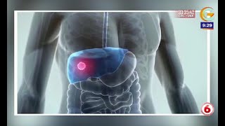 Causas y síntomas de los quistes en el hígado