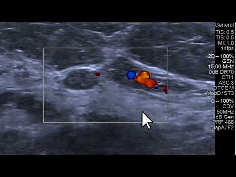 Diferenciação pelo US entre um nódulo sólido, um cisto complicado e uma ilhota de gordura na mama