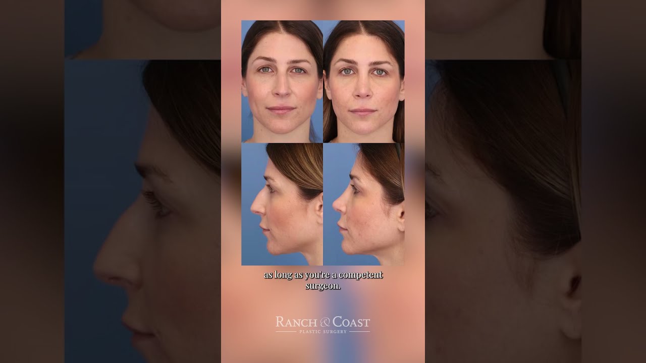 How to Pick a Surgeon for Rhinoplasty