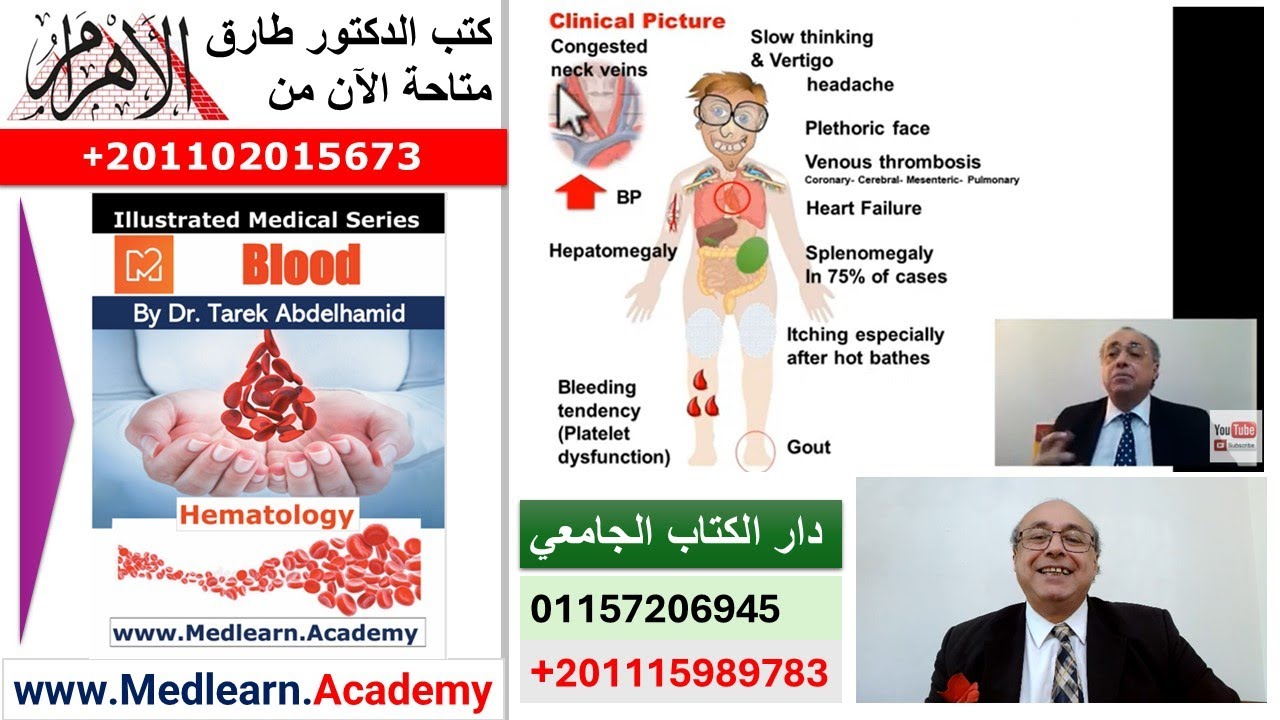 Polycythemia Rubra Vera (PRV)  #cme #internal_medicine #medical #usmle #محاضرات_باطنة