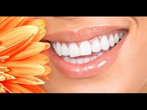comment poser appareil dentaire