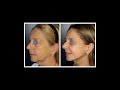 Avant / Après : Lifting facial – Résultats d’opération sur plusieurs patients