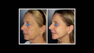 Avant / Après : Lifting facial – Résultats d’opération sur plusieurs patients