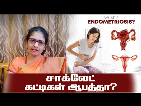 Can you conceive with a chocolate cyst? ( Endometrioma)