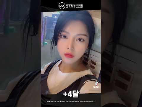 미니리프팅+코성형+매몰+뒤트임