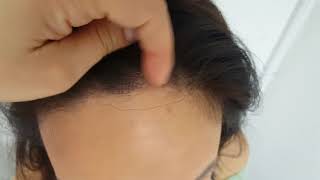 Scalp Healed receding thinning female hairline Microblading Result from 1st session by El Truchan