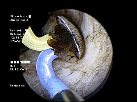 adenoma bilobato prostata