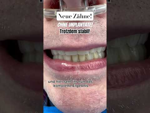Zahnersatz OHNE Implantate! Trotzdem stabil? JA! #zahnarzt #neuezähne #schönezähne #zahnersatz