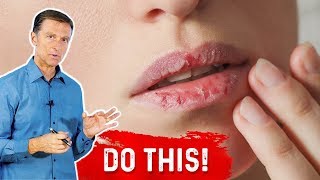 How To Fix Your Chapped Lips? – Dr.Berg On  Remedy For Chapped Lips