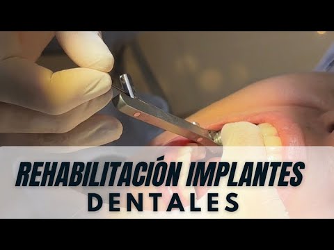 REHABILITATION WITH DENTAL IMPLANTS IN COLOMBIA / DRA JOHANNA CALDERÓN