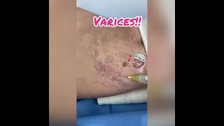 Adiós varices!!!