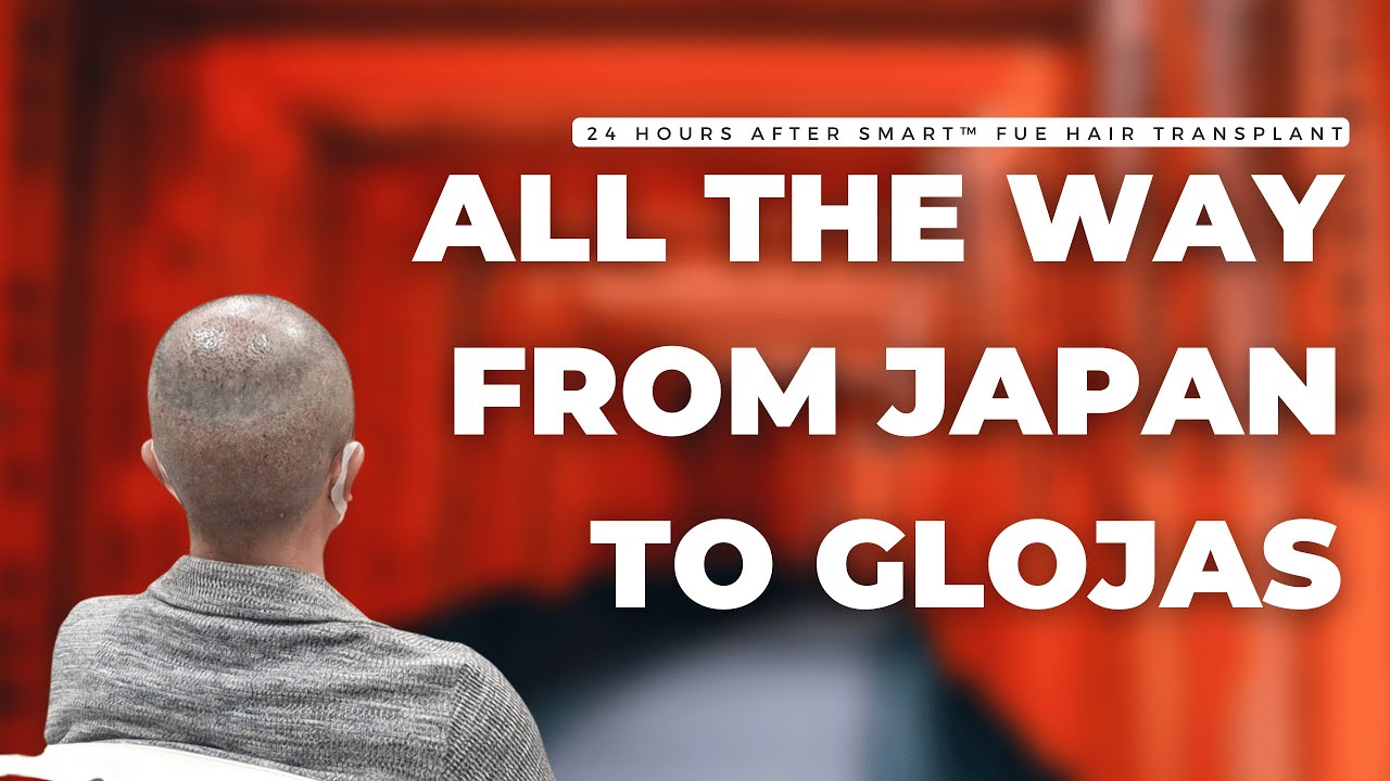 ALL THE WAY FROM JAPAN TO GLOJAS | HAIR TRANSPLANT | MALE PATTERN HAIRLOSS LEVEL 3 VERTEX