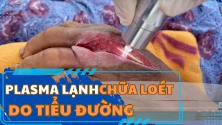 PlasmaMED: Tia plasma lạnh điều trị vết loát biến chứng tiểu đường, lâu lành