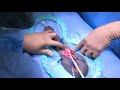 Penoscrotal Placement Of The AMS 700 With MS Pump Penile Prosthesis