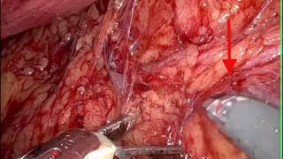 Core Videos (2024): Robotic Retroperitoneal Lymph Node Dissection