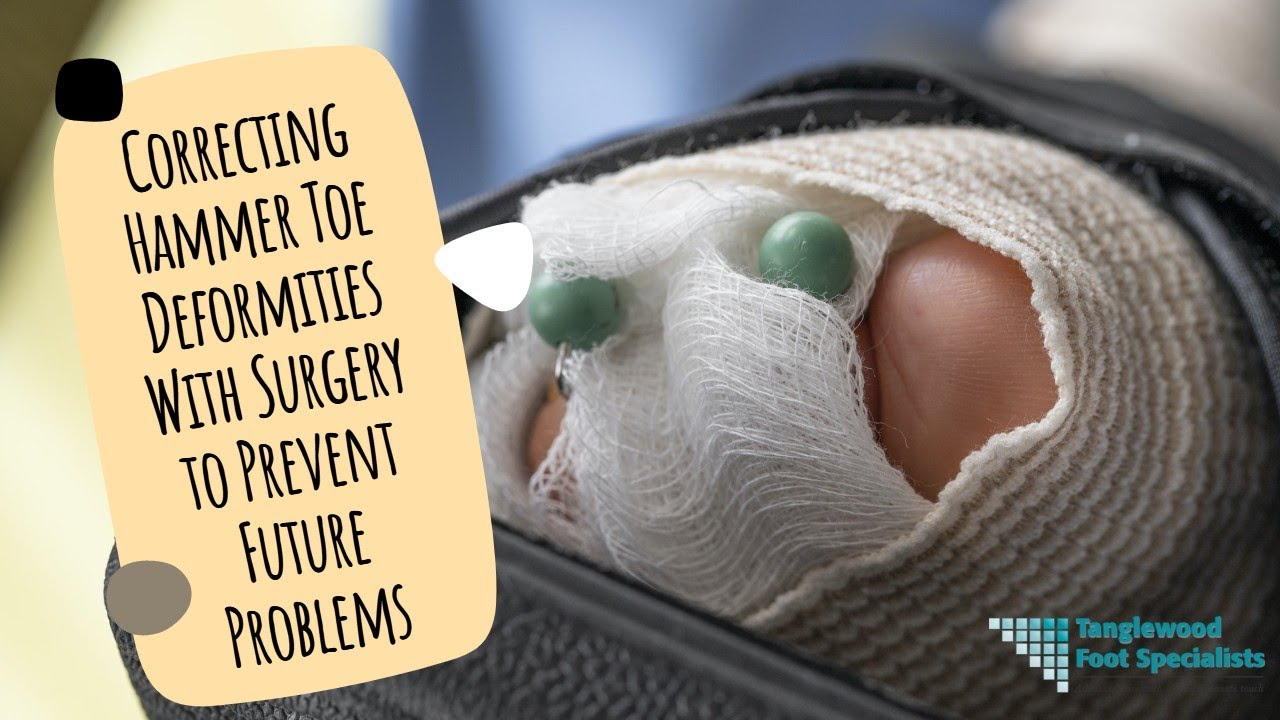 Correcting Hammer Toe Deformities With Surgery to Prevent Future Problems