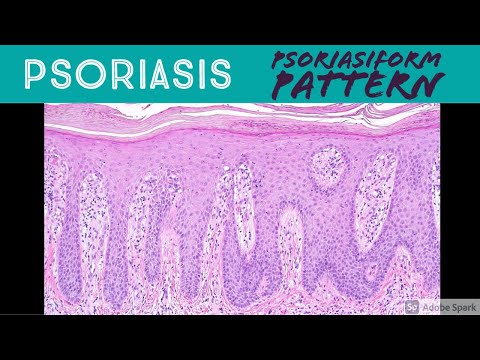 When does psoriasis start