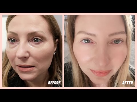 Under Eye Filler | Before & After | My Experience